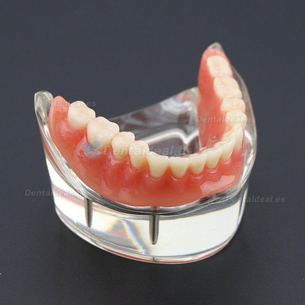 Dientes inferiores dental Modelo de sobredentadura 4 implantes Demostración Modelo 6002 02